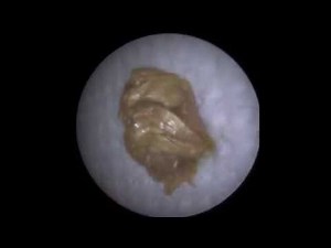 Endoscopic Ear Suction of 'Keratosis Obturans' - Mr Neel Raithatha (The Hear Clinic)