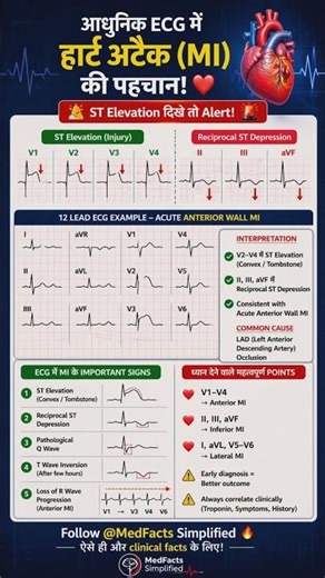 ECG में Heart Attack पहचानना सीखो 🔥 | ST Elevation Explained ECG में HeartAttack🔥#cardiology #ecg