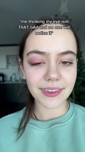 Dealing with Teenager Stye Pain: Relatable Experience