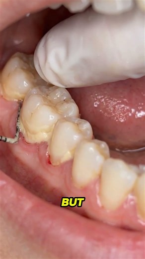 bacteria attaching to teeth #oralhealth