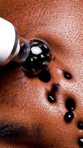 Blackhead Extraction Satisfying or Gross