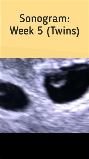 Sonogram: Week 5 (Twins)