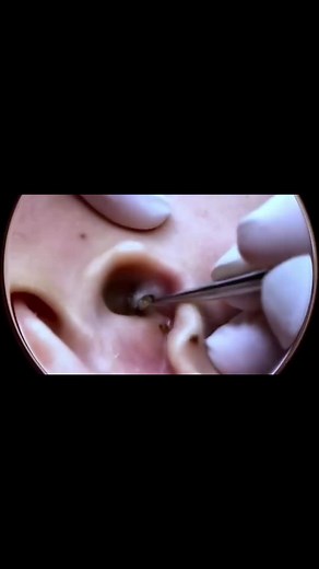 big pimple blackhead removal #acne #pimple #blackhead