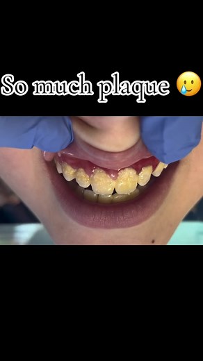Should’ve made this patient brush his teeth before I started his clean 😱 #dentist #dental #teeth #dentalhygienist #oral #asmar