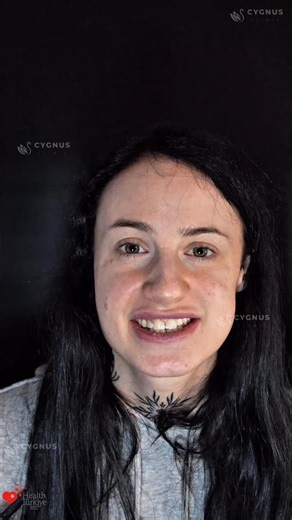 This procedure belongs to a real patient. The date of the medical procedure is 29.12.2025. The date on which the post-procedure visual was taken is 06.01.2026. The treatments are provided within the scope of international health tourism and are carried out at authorized affiliated healthcare institutions in accordance with applicable regulations. | Cygnus Clinic