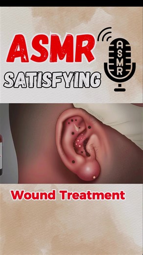 Wound Cleaning ASMR: Satisfying Ear Care Treatment