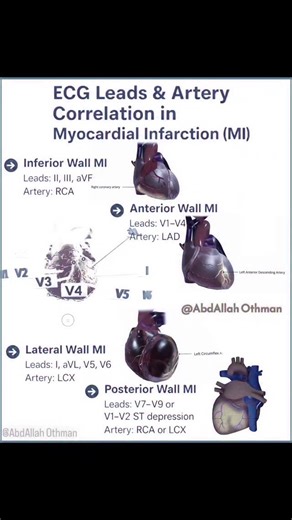21K views · 1.7K reactions | Essential correlation between ECG leads and coronary anatomy. #Cardiology #ECG #EKG #STEMI #MI #HeartAttack #MedicalEducation #ClinicalPearls #MedStudent #FOAMed | Abdallah Othman | Facebook