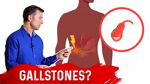 Does Fasting Cause Gallstones? | Dr. Berg