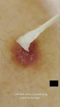 Medical Coding Clarified Biopsy Skin Nevus