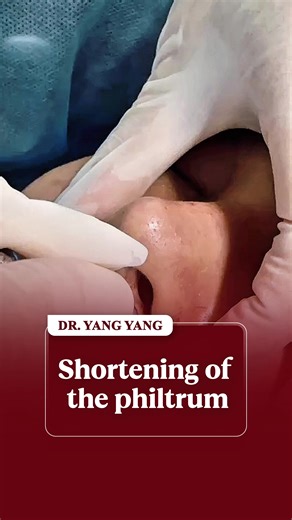 Part 18 | 👉 Is this a lip lift surgery? Please comment to let the doctor know. #liplift #surgery #fyp #job #dryang