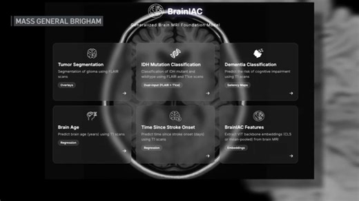 New AI tool aims to spot warning signs in the brain before doctors