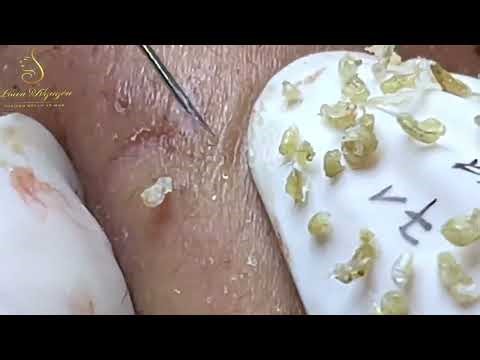 Loan Nguyen Reveals SHOCKING Acne Treatment Techniques