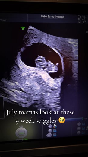 9-Week Ultrasound Wiggles of Pregnant Moms