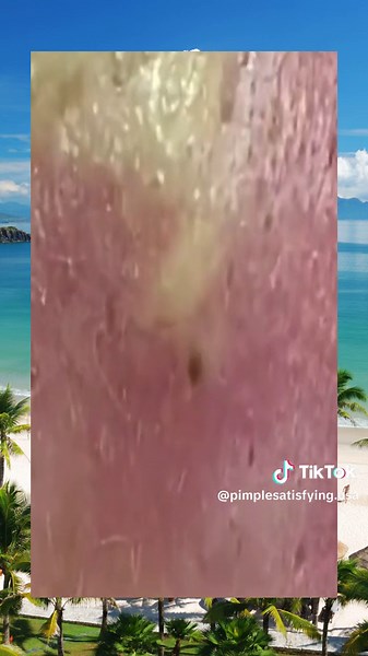 skincare acne squeeze satisfying pimple extraxtion explore (428)