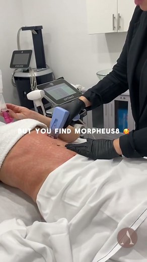 Morpheus 8 for Body Shaping