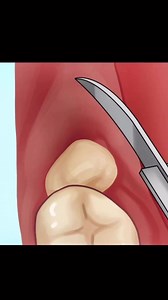 3.1K views · 55 reactions | Episode 1: filling process Anastasia process and wisdom Impected tooth extraction 醴醴醴瘟瘟 | Dr Sameen Jan | Facebook