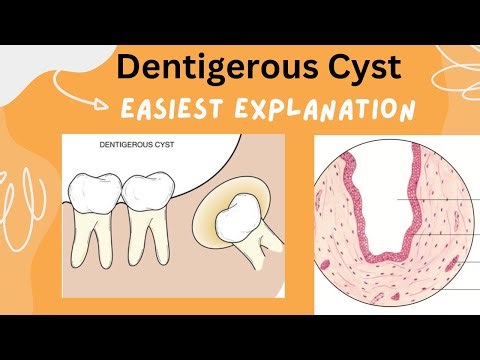 Dentigerous Cyst | Eruption Cyst | Learn in 5 minutes | Oral Pathology | BDS 3rd year