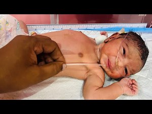 Newborn Baby NG Suction Procedure | How NG Suction Is Performed for Newborn