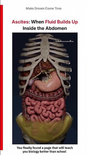 🫃Ascites: When Fluid Builds Up 💧 Inside the Abdomen 🫁 | MDCT