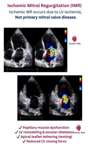 Ischemic Mitral Regurgitation (IMR) #heartdisease #cardiologyeducation #cardiacimaging #heartvalve