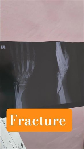 FRACTURE #fracture #fracturetreatment #casting #cast #plaster