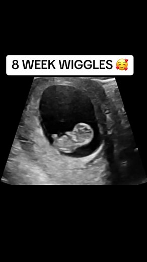 8 Week Pregnancy Ultrasound: Baby's First Movements