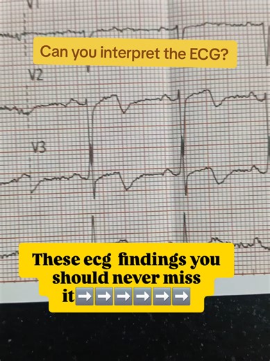 How to Interpret ECG Readings