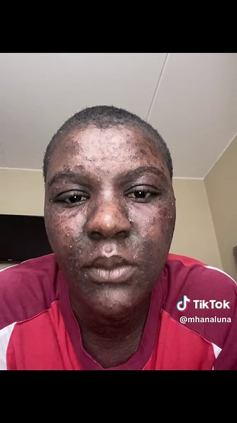 Understanding Pemphigus Foliaceus and Personal Recovery