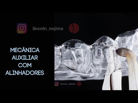 Biomecânicas e mecânicas auxiliares com alinhadores ortodônticos