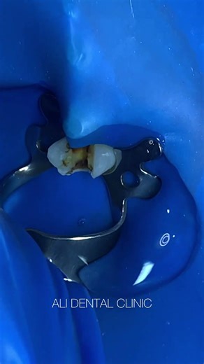 Rubber dam isolation #dentist