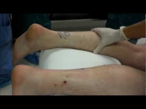 Achilles Tendon Rupture Calf Exam - Thompson Test