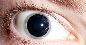 Mydriasis (extreme verwijding van de pupil): symptomen, oorzaken en behandeling