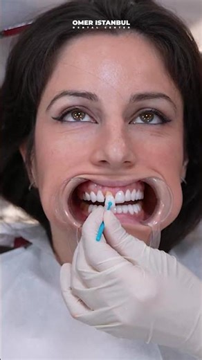 Before & After with Laminate Veneers | Morgane’s Digital Smile Design Results