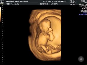 13 Week 4D Ultrasound