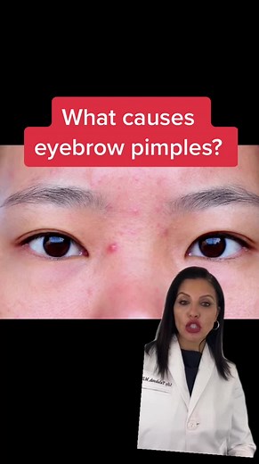 Causes and Treatment of Acne Between Eyebrows