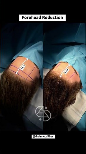 Forehead Reduction 💆🏼‍♀️ 8 cm to 6 cm 📏 Dr. Ahmet Dilber #foreheadreduction #hairlinelowering