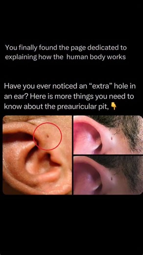 The Human Body 🧬 on Instagram: "Follow @explainingthebody to learn everything about the human body one post at a time 🧠⚙️ Have you ever noticed a tiny, subtle pit or dimple right near the front of your ear, where the cartilage of the ear meets your face? If so, you’ve spotted a preauricular pit, also sometimes called a preauricular sinus. This small, almost invisible hole is actually a harmless birth defect . It is a congenital abnormality that forms during the early stages of fetal developmen