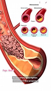 What is atherosclerosis? Atherosclerosis thickening or hardening of the arteries. | Med G