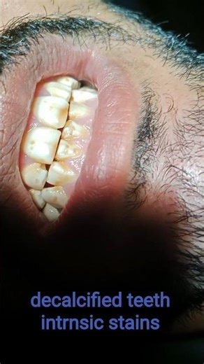 Intrinsic Stain of teeth declcification #dentist #shortvideo #shortsfeed #