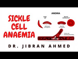 SICKLE CELL ANAEMIA II HEMOLYTIC ANAEMIA II ROBBINS 10TH E II PATHOLOGY LECTURE