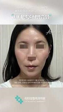 티티 얼굴지방흡입 한 끗 차이의 라인 미학🎀