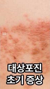 대상포진, 방치하면 평생 고통될 수 있습니다 #건강습관 #건강한중년 #지식