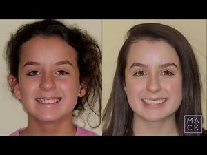 Before and after for severe crowding without extractions: Traditional Braces