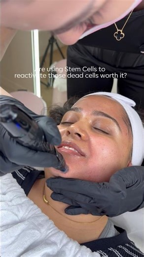 What to expect during Microneedling 👇🏼