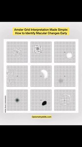 Learn how to interpret Amsler grid findings in clinical practice, including metamorphopsia, central and paracentral scotomas, and early signs of macular disease for timely detection and referral. #AmslerGrid #MacularAssessment #MacularHealth #OptometryEducation #ClinicalOptometry #RetinaCare #EarlyDetectionMatters #Metamorphopsia #Scotoma #AMD #DiabeticMaculopathy #CSCR #EyeHealthAwareness #OptometryLife #VisionCare | Optometry skills