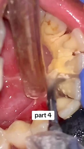 Dental Procedure: Removing a Damaged Tooth