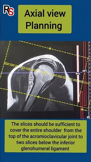 Shoulder MRI Planning #radiology #MRIplanning #mri #radiographer