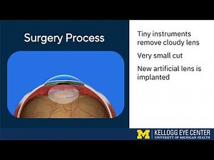 Cataract Surgery – Education Video
