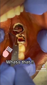 Pulp polyp ! Gum Boil