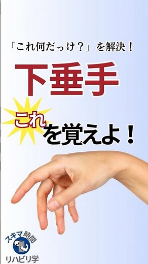 【知らないとマズイ⁉︎】“下垂手”はこれを覚えよう！#理学療法士国家試験 #作業療法士国家試験 #理学療法士 #作業療法士 #基礎 #臨床 #臨床実習 #末梢神経 #橈骨神経 #橈骨神経麻痺 #下垂手